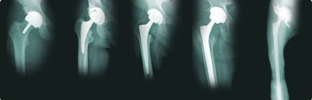 csípőprotézis lehetőségei arthrosisban