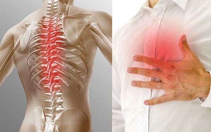 Mellkasi osteochondrosis és mellkasi fájdalom