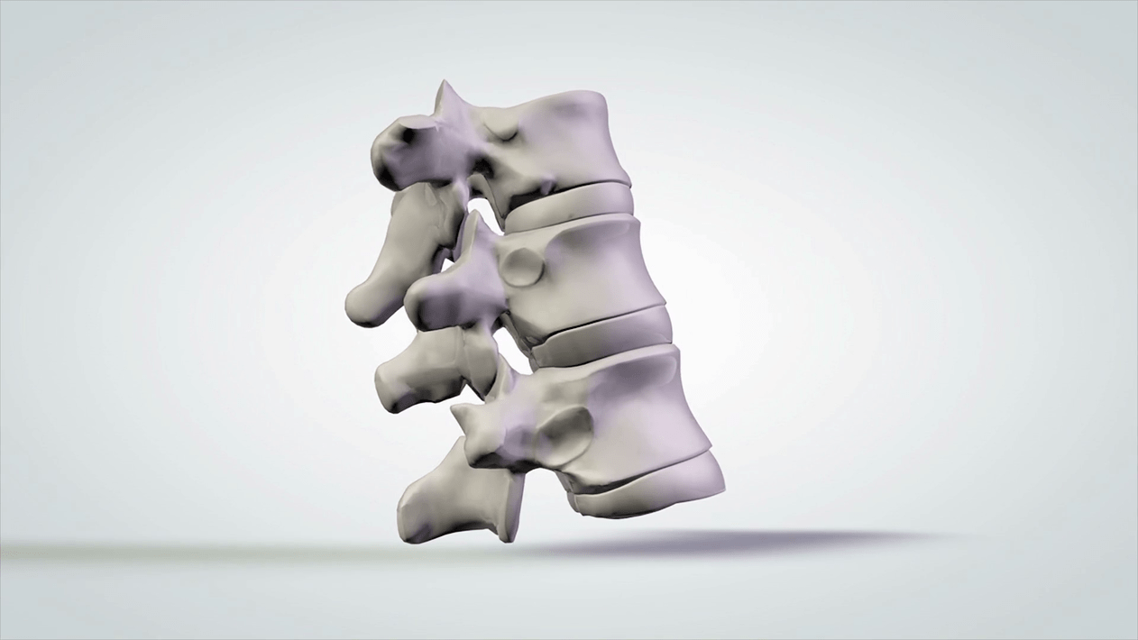 a gerinc károsodása a nyaki osteochondrosis miatt