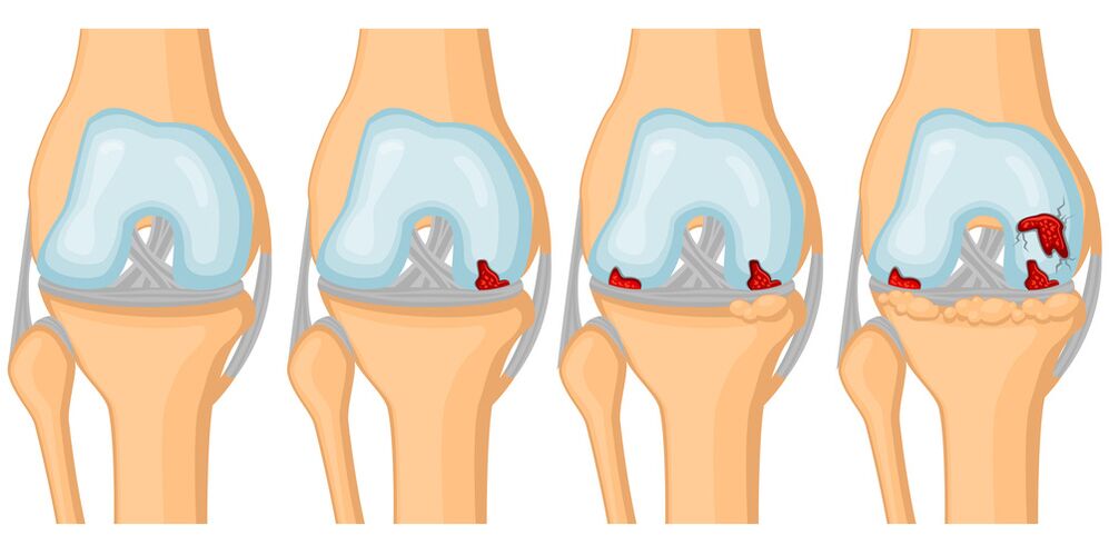Az ízületi arthrosis fejlettségi foka