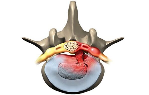 osteochondrosis által érintett csigolya