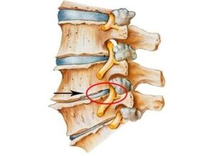 az osteochondrosis jelei és tünetei